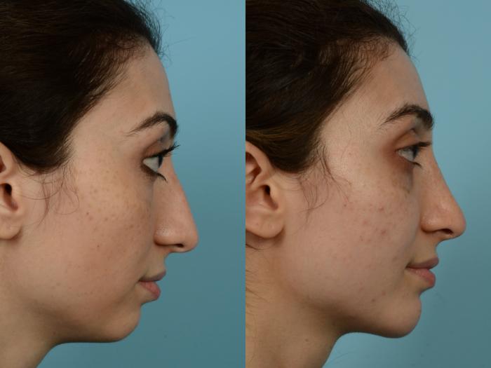Before & After Rhinoplasty by Dr. Mustoe Case 815 Right Side View in Chicago, IL