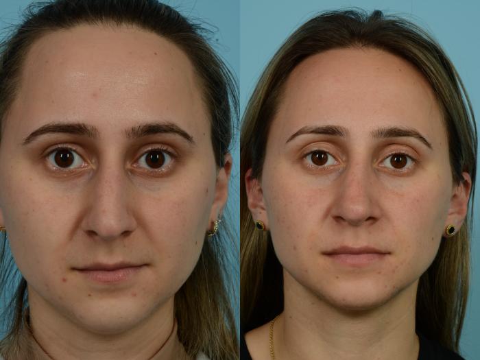 Before & After Rhinoplasty by Dr. Mustoe Case 816 Front View in Chicago, IL