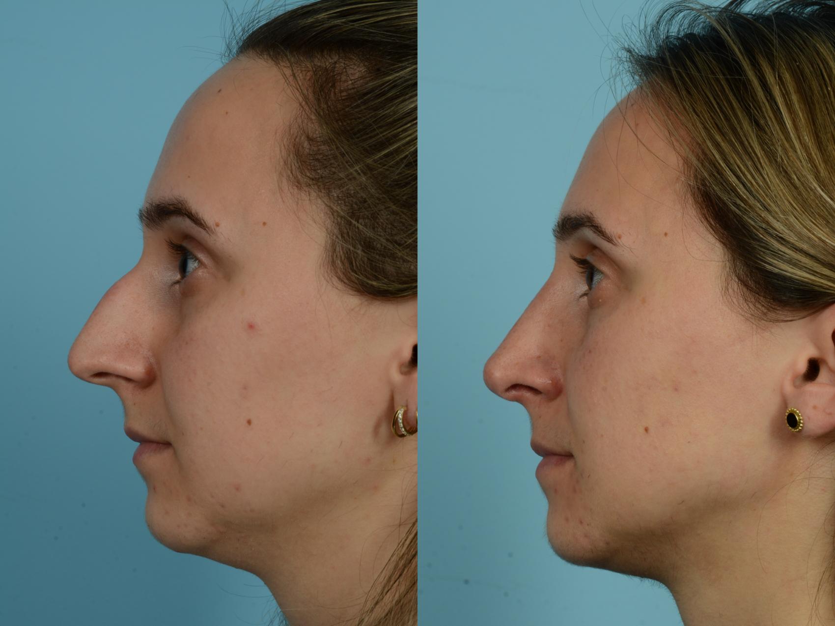 Before & After Rhinoplasty by Dr. Mustoe Case 816 Left Side View in Chicago, IL