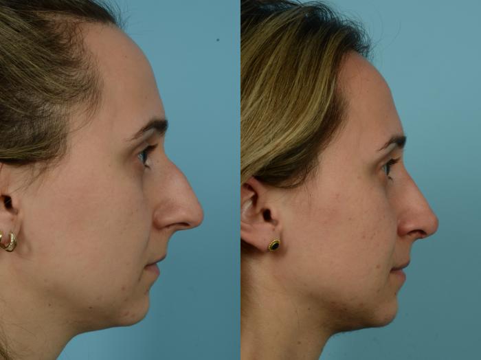 Before & After Rhinoplasty by Dr. Mustoe Case 816 Right Side View in Chicago, IL