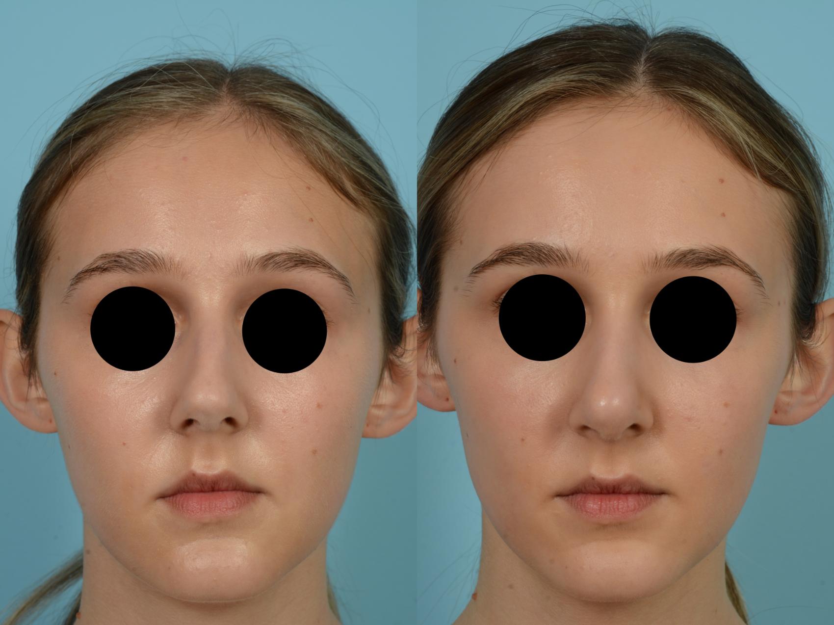 Before & After Rhinoplasty by Dr. Mustoe Case 818 Front View in Chicago, IL
