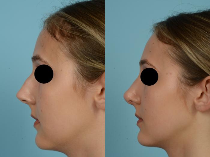 Before & After Rhinoplasty by Dr. Mustoe Case 818 Left Side View in Chicago, IL