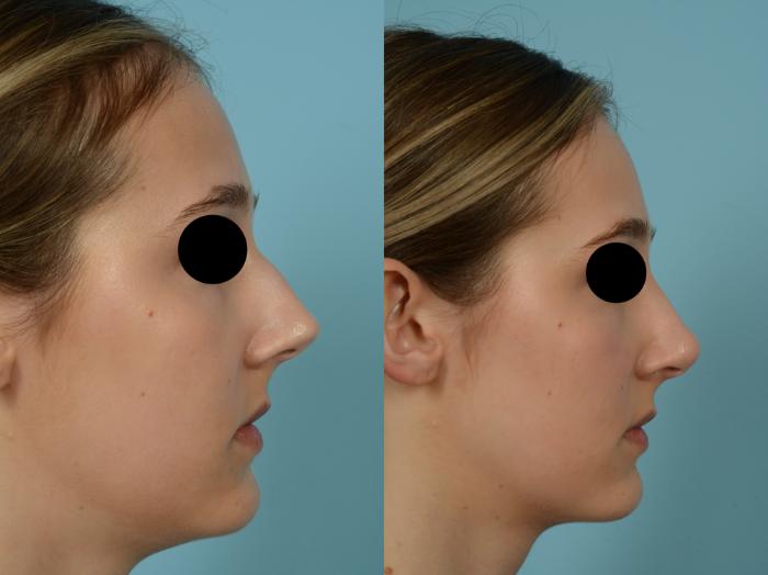 Before & After Rhinoplasty by Dr. Mustoe Case 818 Right Side View in Chicago, IL