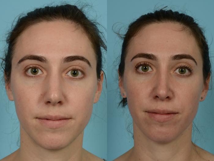 Before & After Rhinoplasty by Dr. Mustoe Case 821 Front View in Chicago, IL