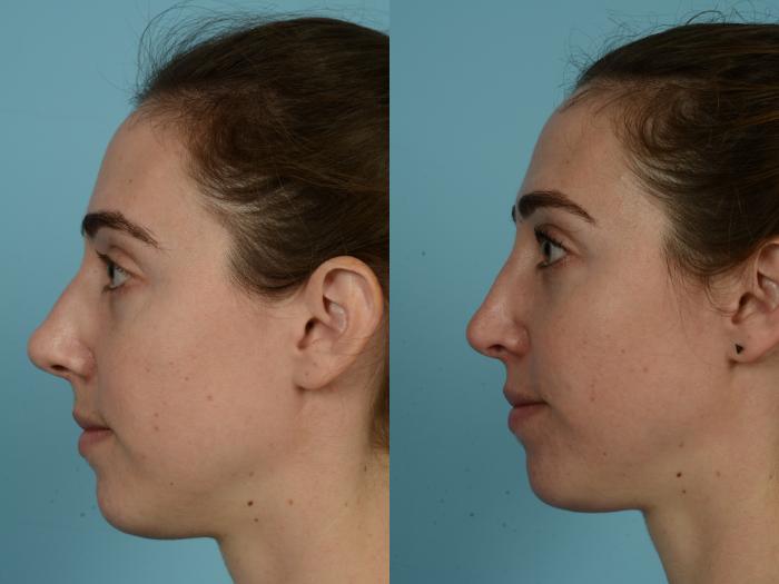Before & After Rhinoplasty by Dr. Mustoe Case 821 Left Side View in Chicago, IL
