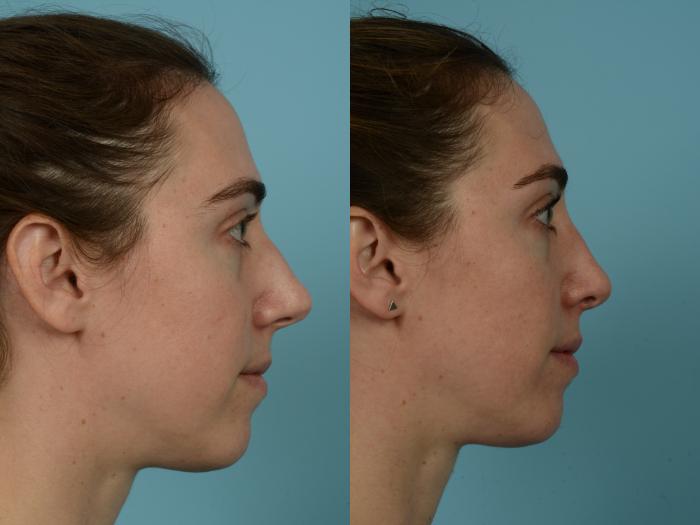 Before & After Rhinoplasty by Dr. Mustoe Case 821 Right Side View in Chicago, IL