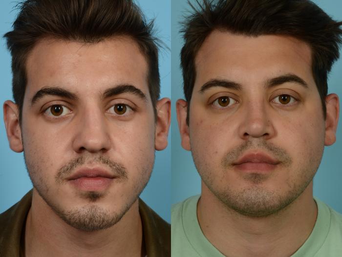 Before & After Rhinoplasty by Dr. Mustoe Case 822 Front View in Chicago, IL