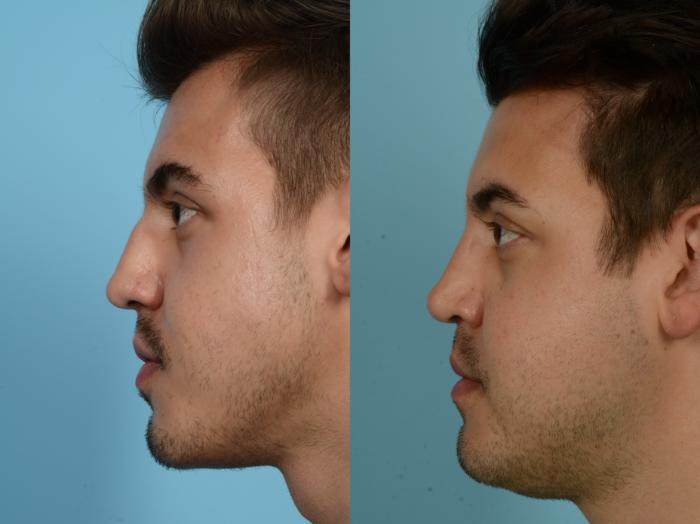 Before & After Rhinoplasty by Dr. Mustoe Case 822 Left Side View in Chicago, IL