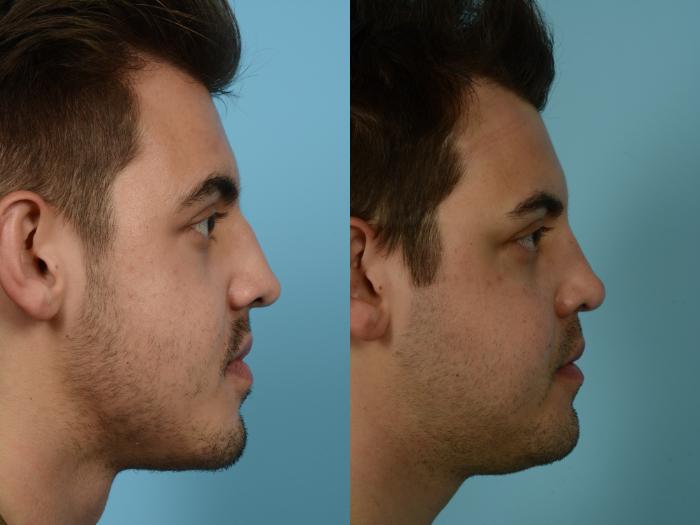 Before & After Rhinoplasty by Dr. Mustoe Case 822 Right Side View in Chicago, IL