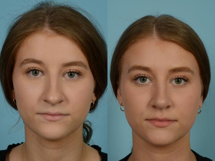 Before & After Rhinoplasty by Dr. Mustoe Case 825 Front View in Chicago, IL