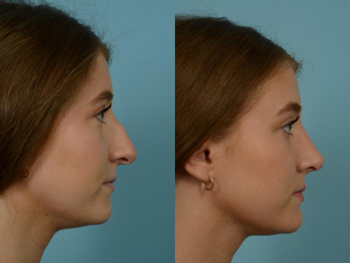 Before & After Rhinoplasty by Dr. Mustoe Case 825 Right Side View in Chicago, IL