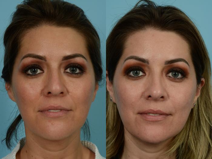 Before & After Rhinoplasty by Dr. Mustoe Case 828 Front View in Chicago, IL