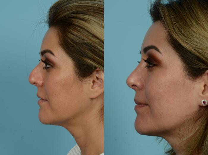 Before & After Rhinoplasty by Dr. Mustoe Case 828 Left Side View in Chicago, IL