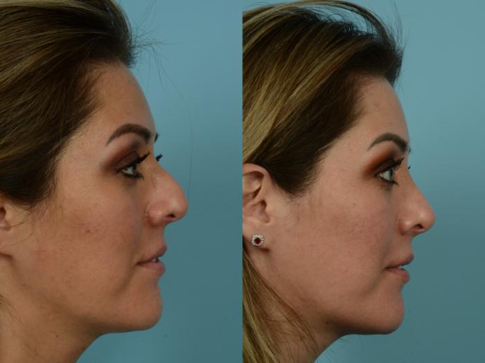 Before & After Rhinoplasty by Dr. Mustoe Case 828 Right Side View in Chicago, IL