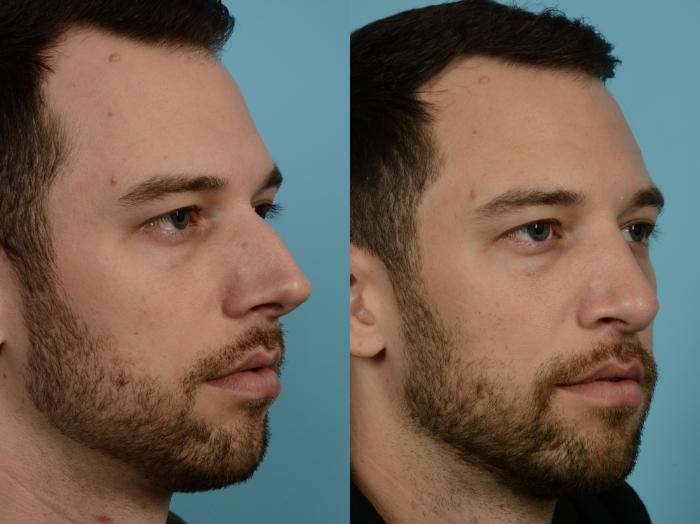 Before & After Rhinoplasty by Dr. Mustoe Case 835 Right Oblique View in Chicago, IL