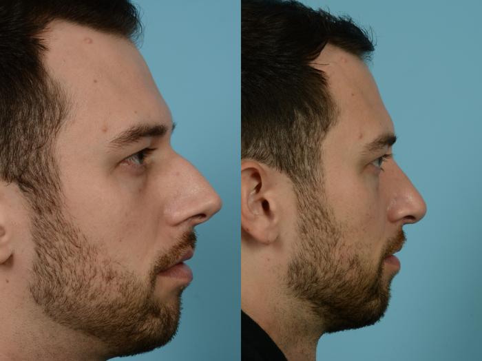 Before & After Rhinoplasty by Dr. Mustoe Case 835 Right Side View in Chicago, IL
