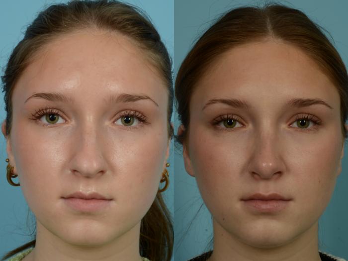 Before & After Rhinoplasty by Dr. Mustoe Case 838 Front View in Chicago, IL