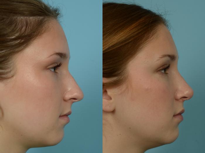 Before & After Rhinoplasty by Dr. Mustoe Case 838 Right Side View in Chicago, IL