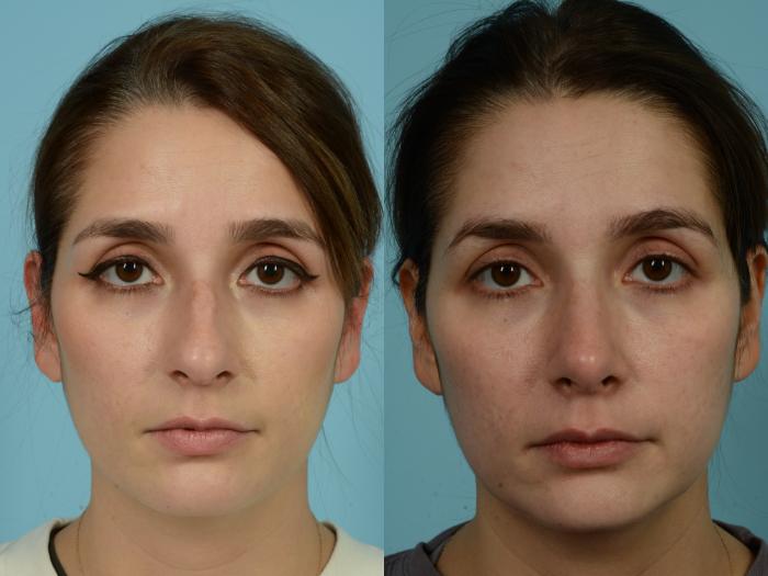 Before & After Rhinoplasty by Dr. Mustoe Case 839 Front View in Chicago, IL