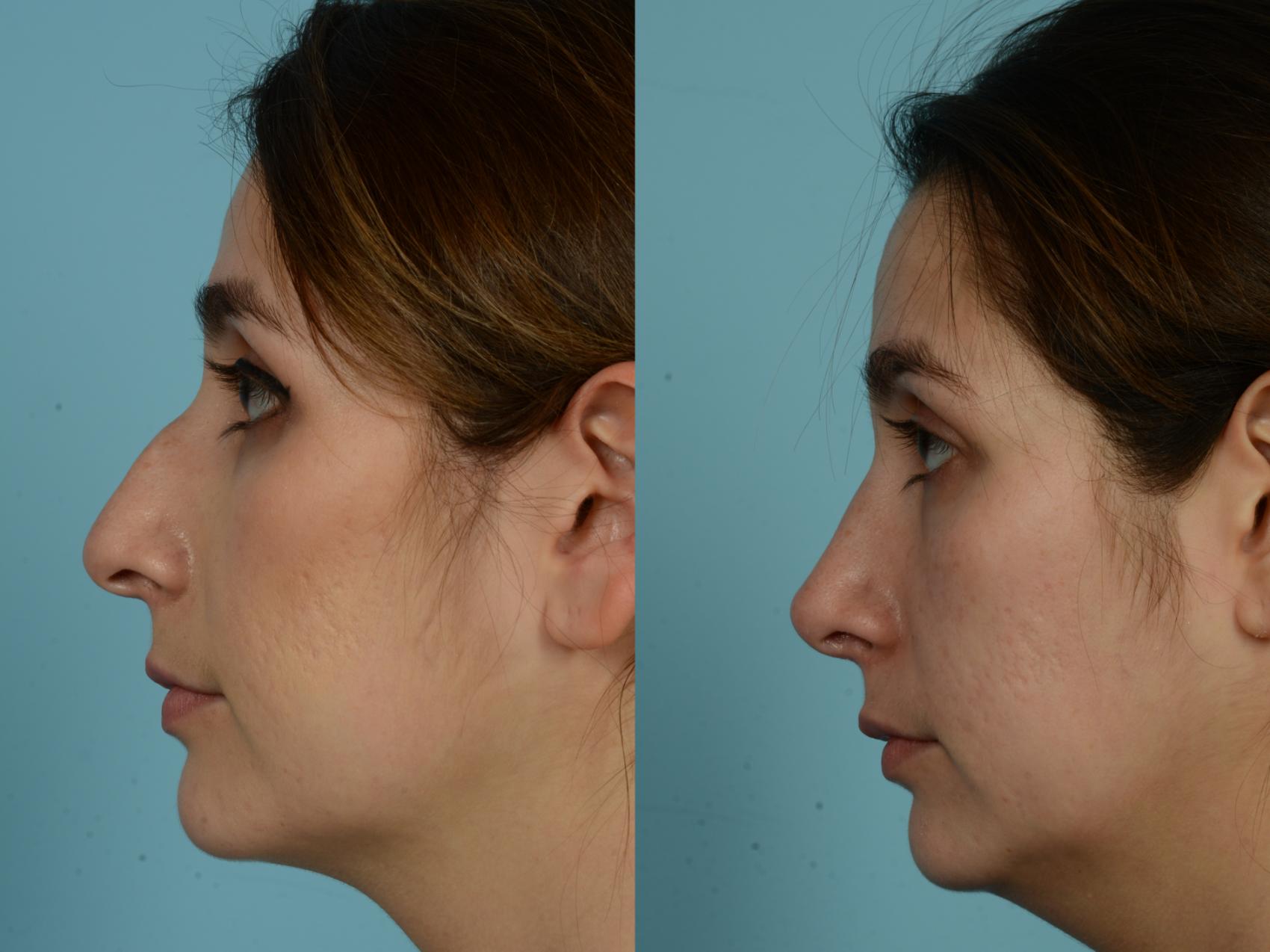 Before & After Rhinoplasty by Dr. Mustoe Case 839 Left Side View in Chicago, IL