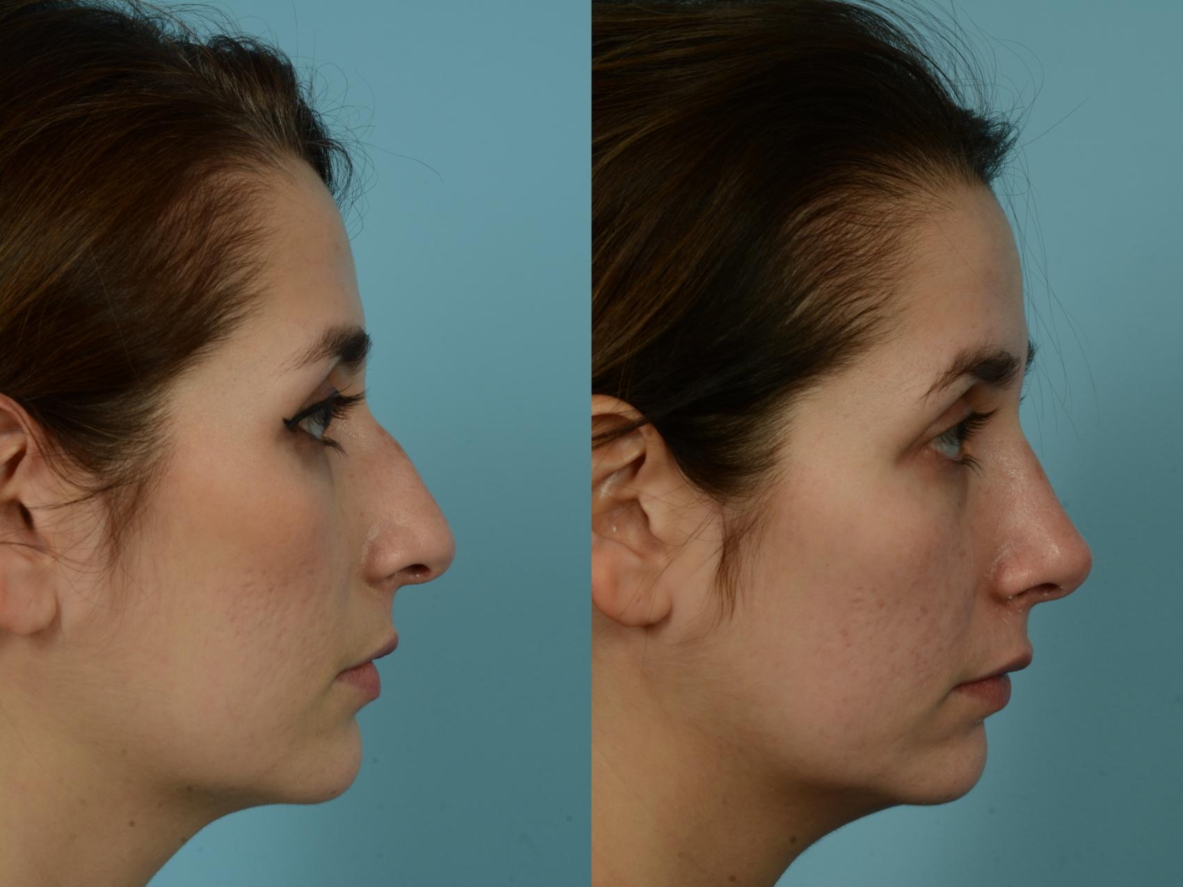 Before & After Rhinoplasty by Dr. Mustoe Case 839 Right Side View in Chicago, IL