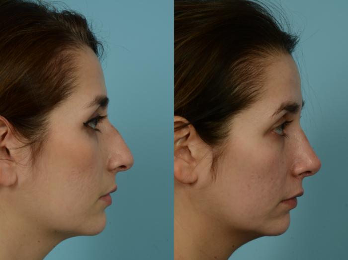 Before & After Rhinoplasty by Dr. Mustoe Case 839 Right Side View in Chicago, IL
