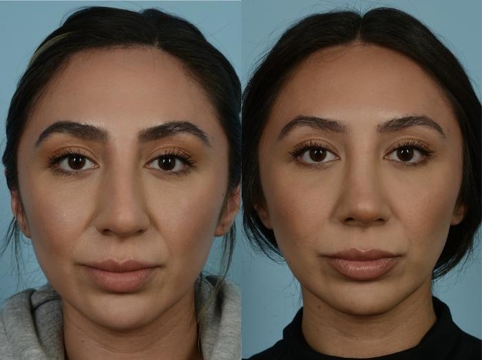 Before & After Rhinoplasty by Dr. Mustoe Case 887 Front View in Chicago, IL