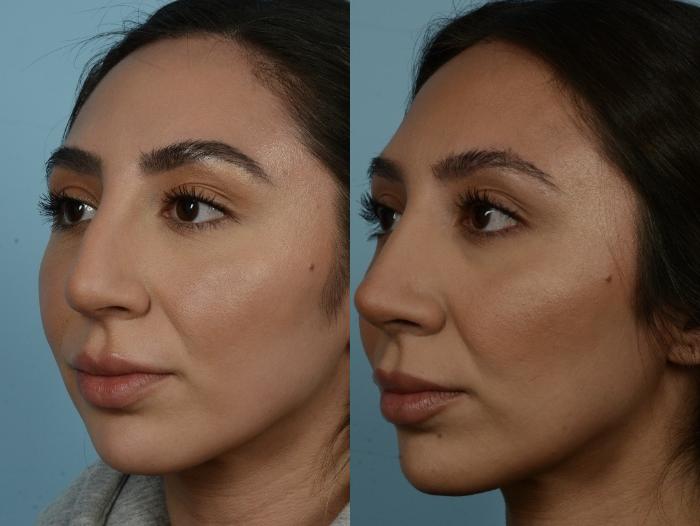 Before & After Rhinoplasty by Dr. Mustoe Case 887 Left Oblique View in Chicago, IL