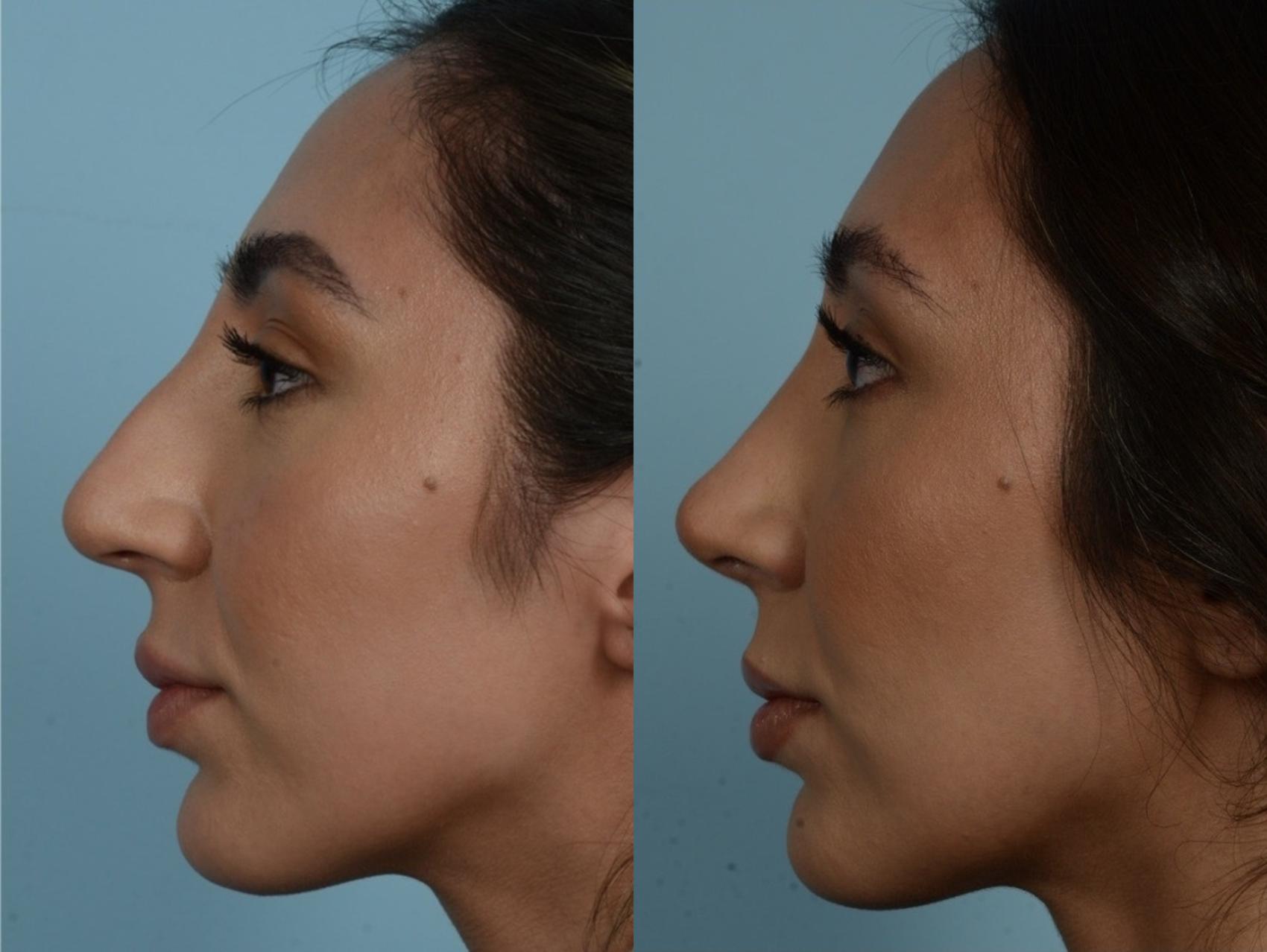 Before & After Rhinoplasty by Dr. Mustoe Case 887 Left Side View in Chicago, IL