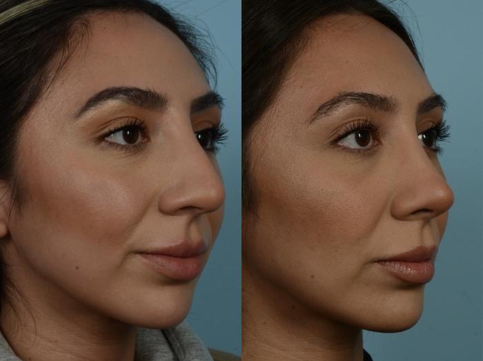 Before & After Rhinoplasty by Dr. Mustoe Case 887 Right Oblique View in Chicago, IL