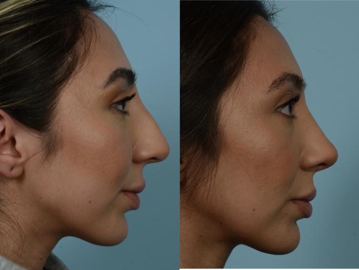 Before & After Rhinoplasty by Dr. Mustoe Case 887 Right Side View in Chicago, IL