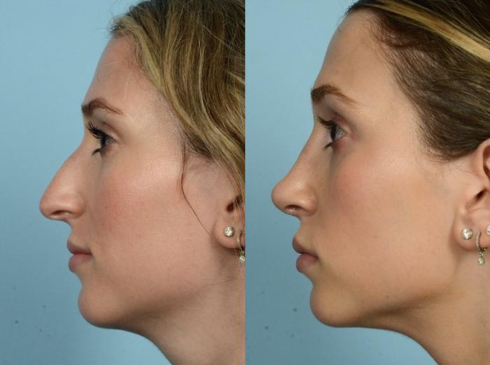 Before & After Rhinoplasty by Dr. Mustoe Case 890 Left Side View in Chicago, IL