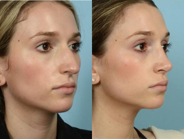 Before & After Rhinoplasty by Dr. Mustoe Case 890 Right Oblique View in Chicago, IL