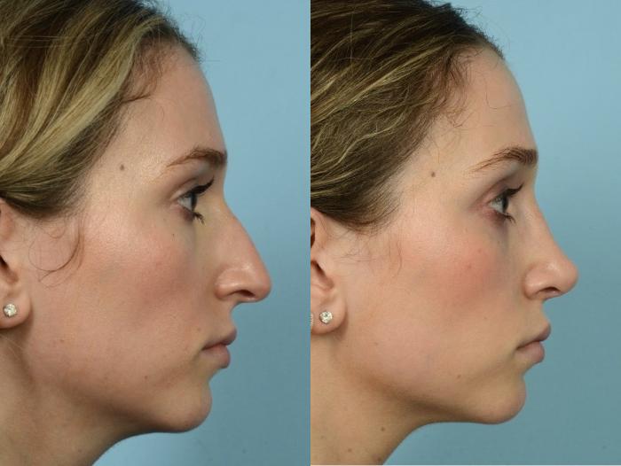 Before & After Rhinoplasty by Dr. Mustoe Case 890 Right Side View in Chicago, IL