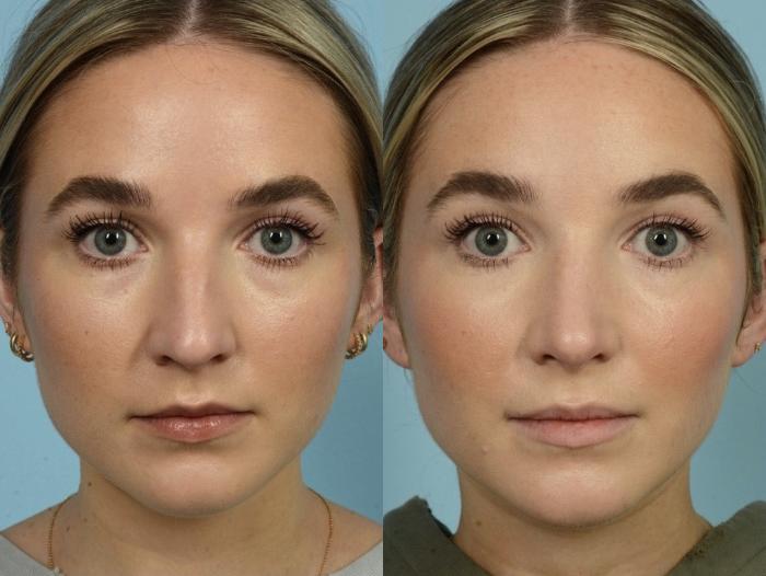 Before & After Rhinoplasty by Dr. Mustoe Case 903 Front View in Chicago, IL