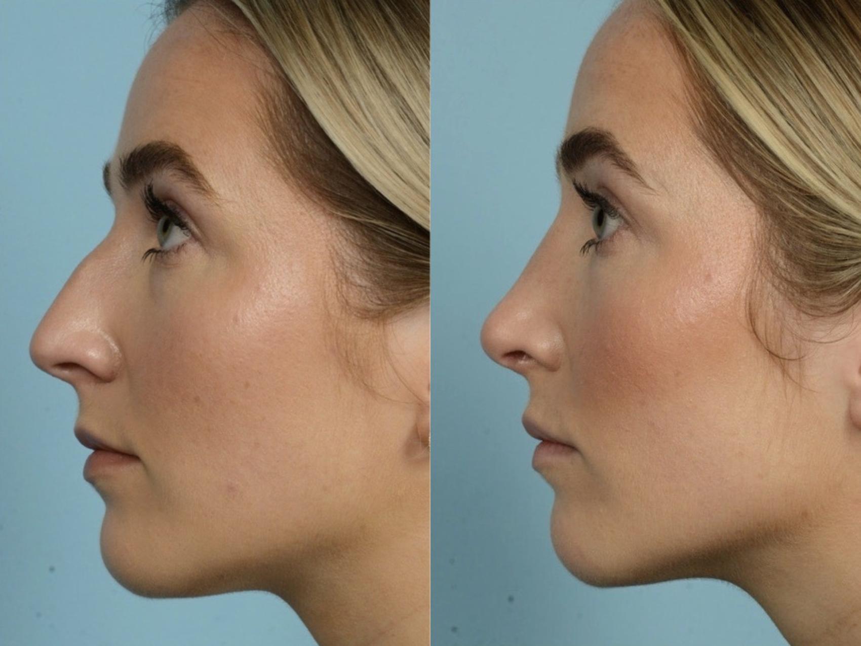Before & After Rhinoplasty by Dr. Mustoe Case 903 Left Side View in Chicago, IL