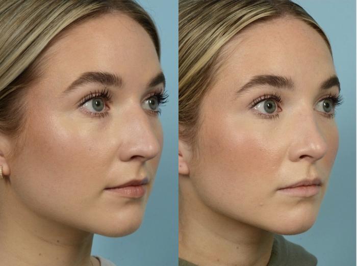 Before & After Rhinoplasty by Dr. Mustoe Case 903 Right Oblique View in Chicago, IL