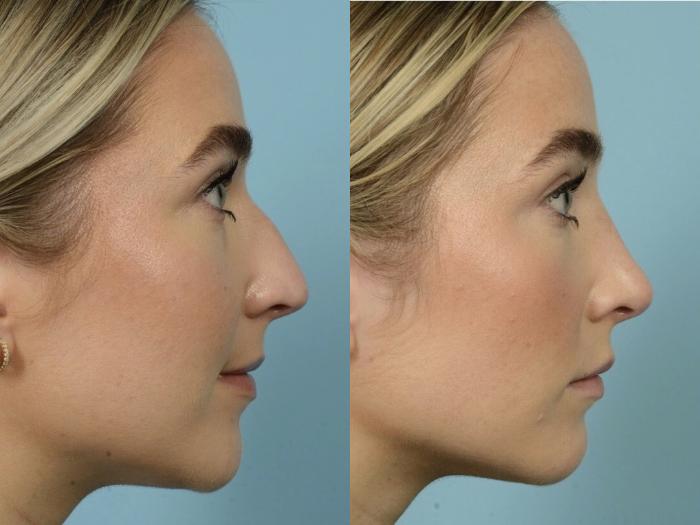 Before & After Rhinoplasty by Dr. Mustoe Case 903 Right Side View in Chicago, IL
