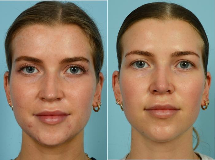 Before & After Rhinoplasty by Dr. Mustoe Case 916 Front View in Chicago, IL