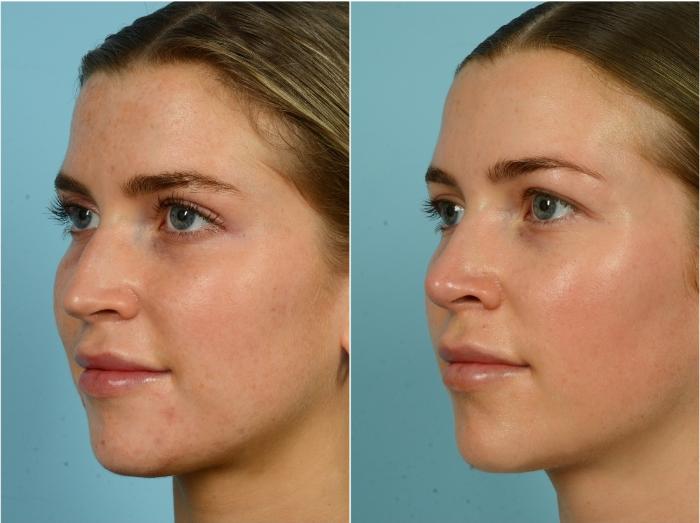 Before & After Rhinoplasty by Dr. Mustoe Case 916 Left Oblique View in Chicago, IL