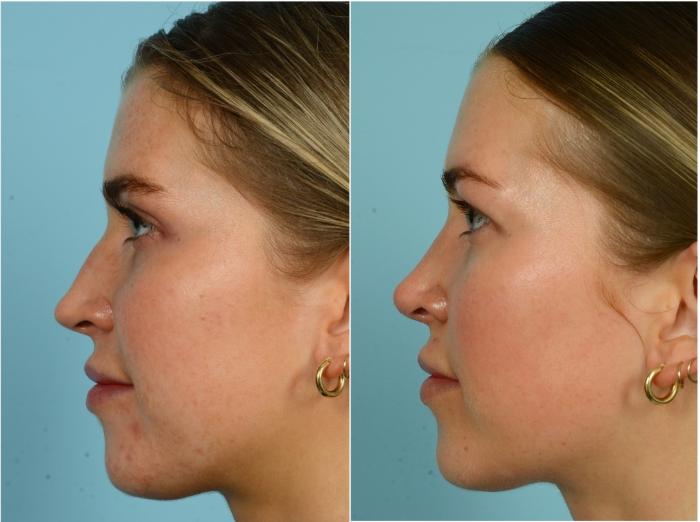 Before & After Rhinoplasty by Dr. Mustoe Case 916 Left Side View in Chicago, IL