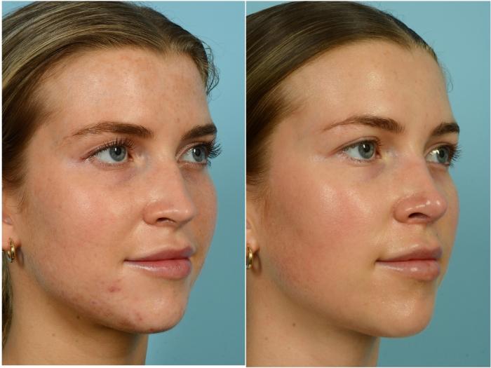 Before & After Rhinoplasty by Dr. Mustoe Case 916 Right Oblique View in Chicago, IL