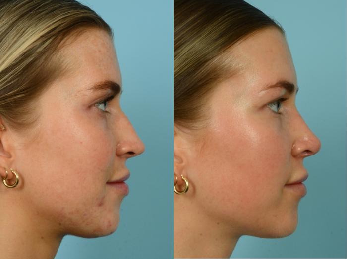 Before & After Rhinoplasty by Dr. Mustoe Case 916 Right Side View in Chicago, IL