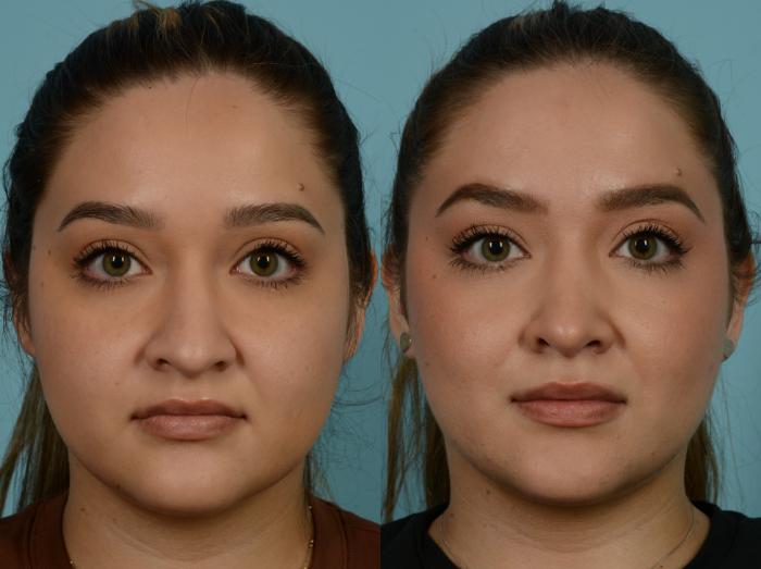 Before & After Rhinoplasty by Dr. Mustoe Case 922 Front View in Chicago, IL