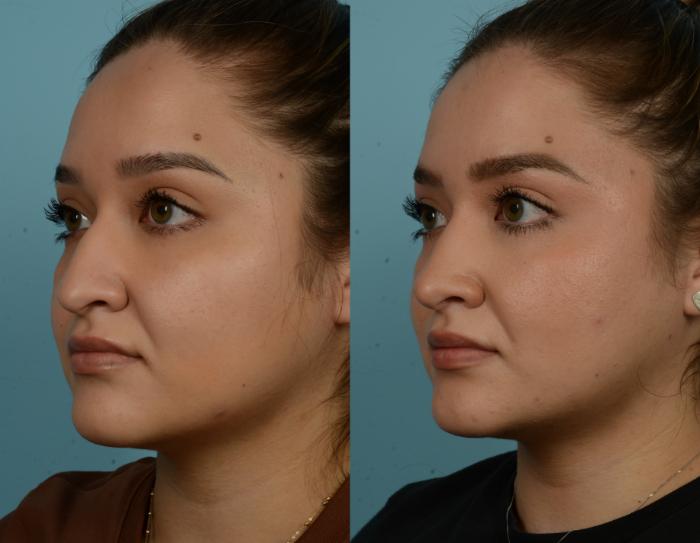 Before & After Rhinoplasty by Dr. Mustoe Case 922 Left Oblique View in Chicago, IL