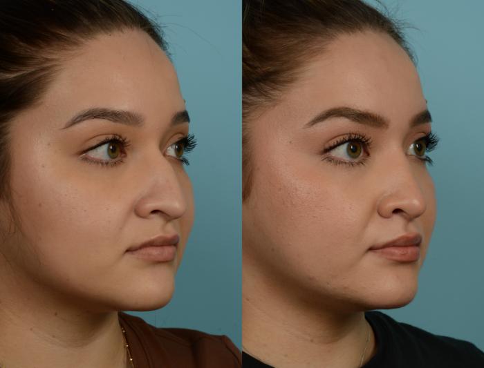 Before & After Rhinoplasty by Dr. Mustoe Case 922 Right Oblique View in Chicago, IL