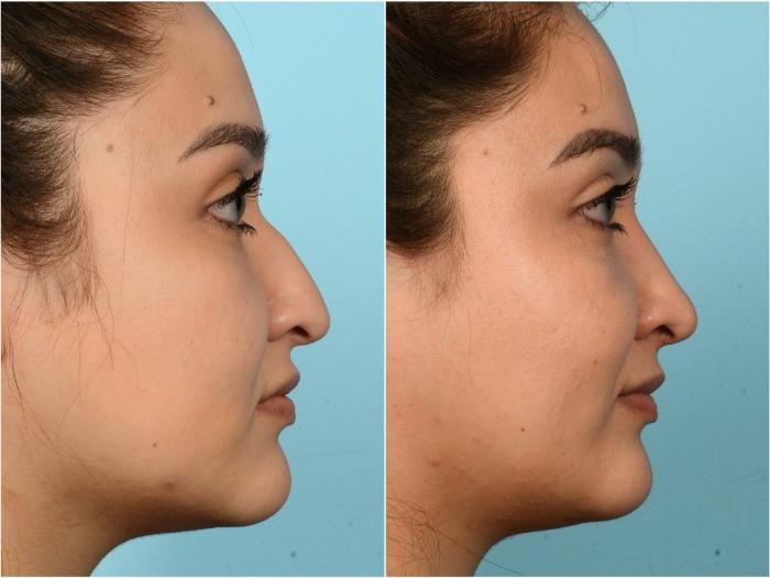 Before & After Rhinoplasty by Dr. Mustoe Case 922 Right Side View in Chicago, IL