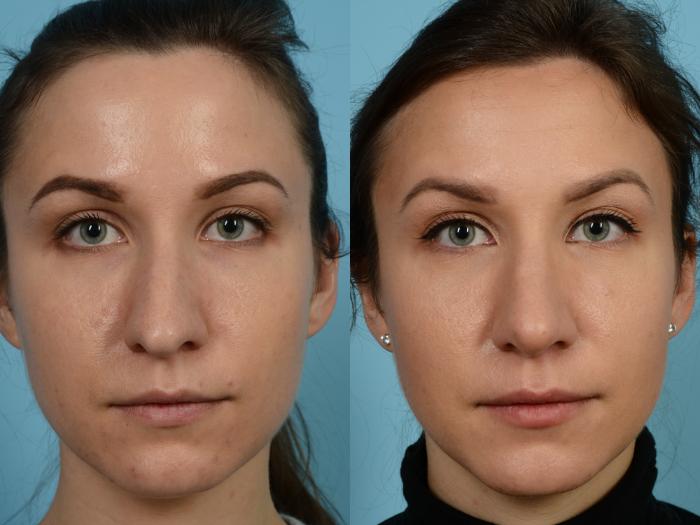 Before & After Rhinoplasty by Dr. Mustoe Case 927 Front View in Chicago, IL