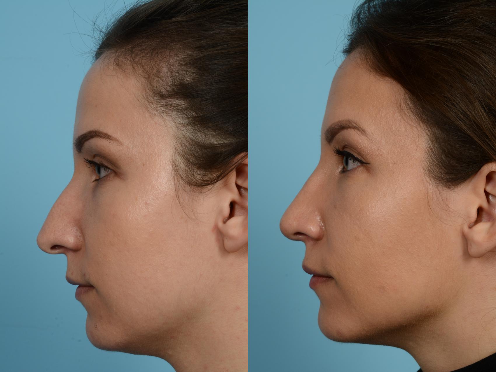 Before & After Rhinoplasty by Dr. Mustoe Case 927 Left Side View in Chicago, IL