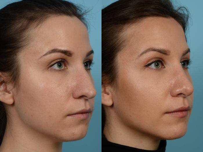 Before & After Rhinoplasty by Dr. Mustoe Case 927 Right Oblique View in Chicago, IL